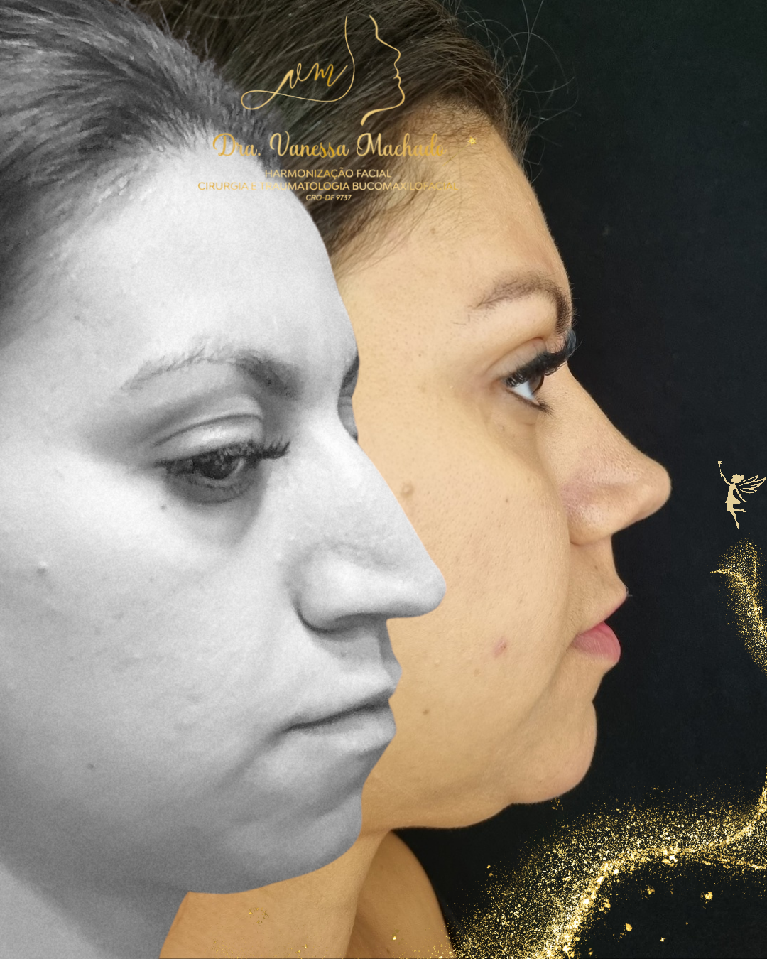 Rinomodelação definitiva estruturada