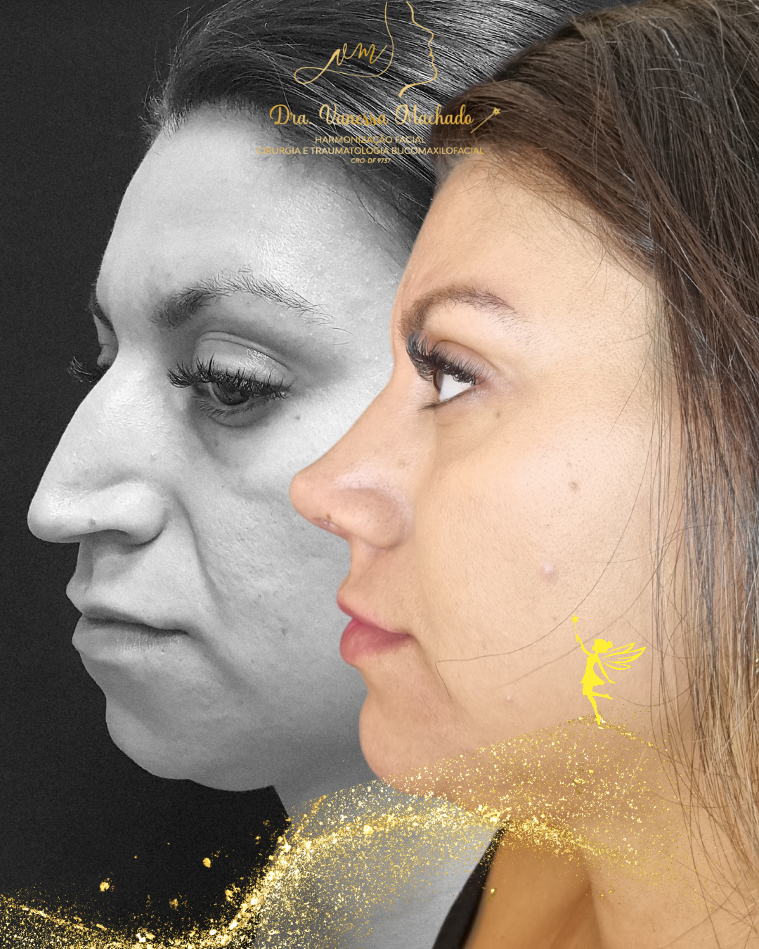 Rinomodelação definitiva estruturada