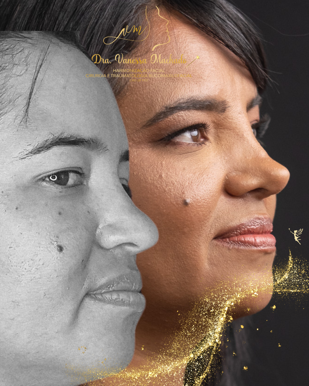 Rinomodelação definitiva estruturada