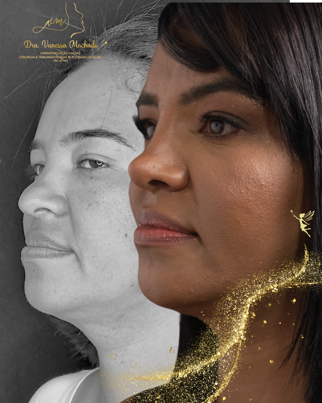 Rinomodelação definitiva estruturada