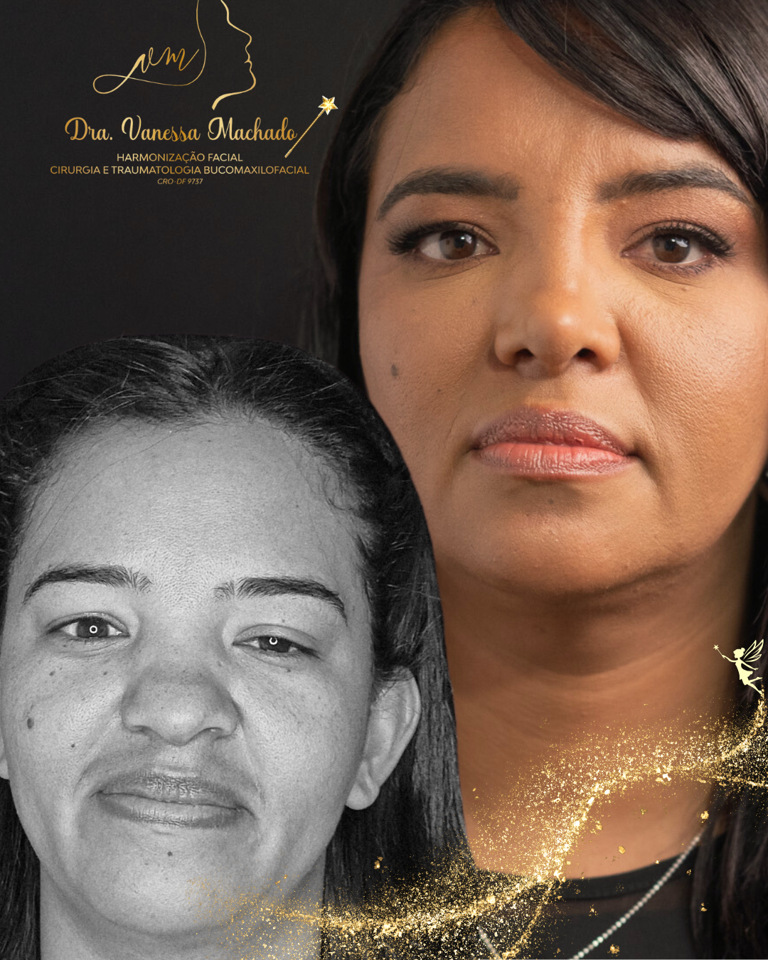 Rinomodelação definitiva estruturada