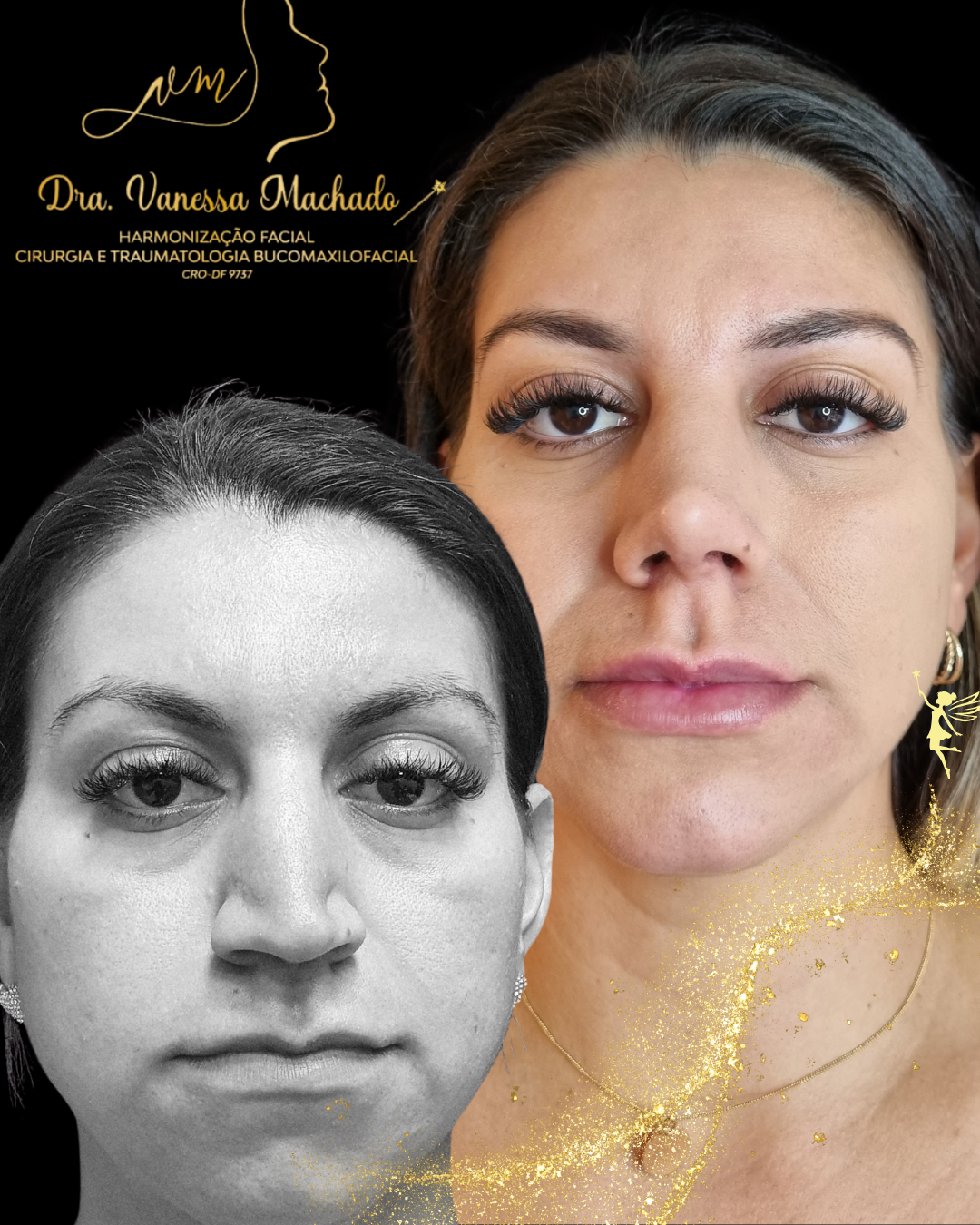 Rinomodelação definitiva estruturada