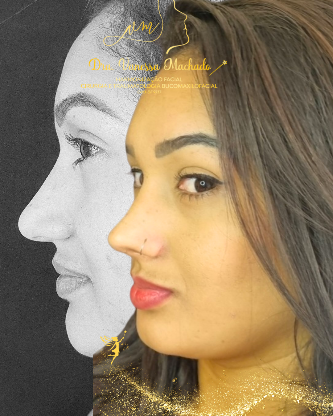 Rinomodelação definitiva estruturada