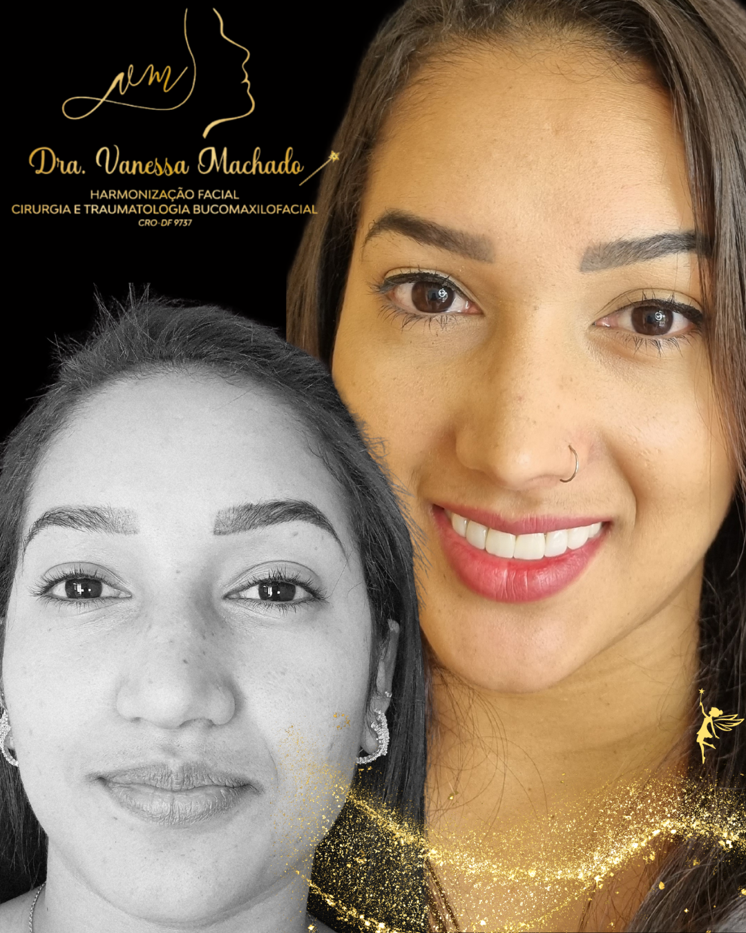 Rinomodelação definitiva estruturada