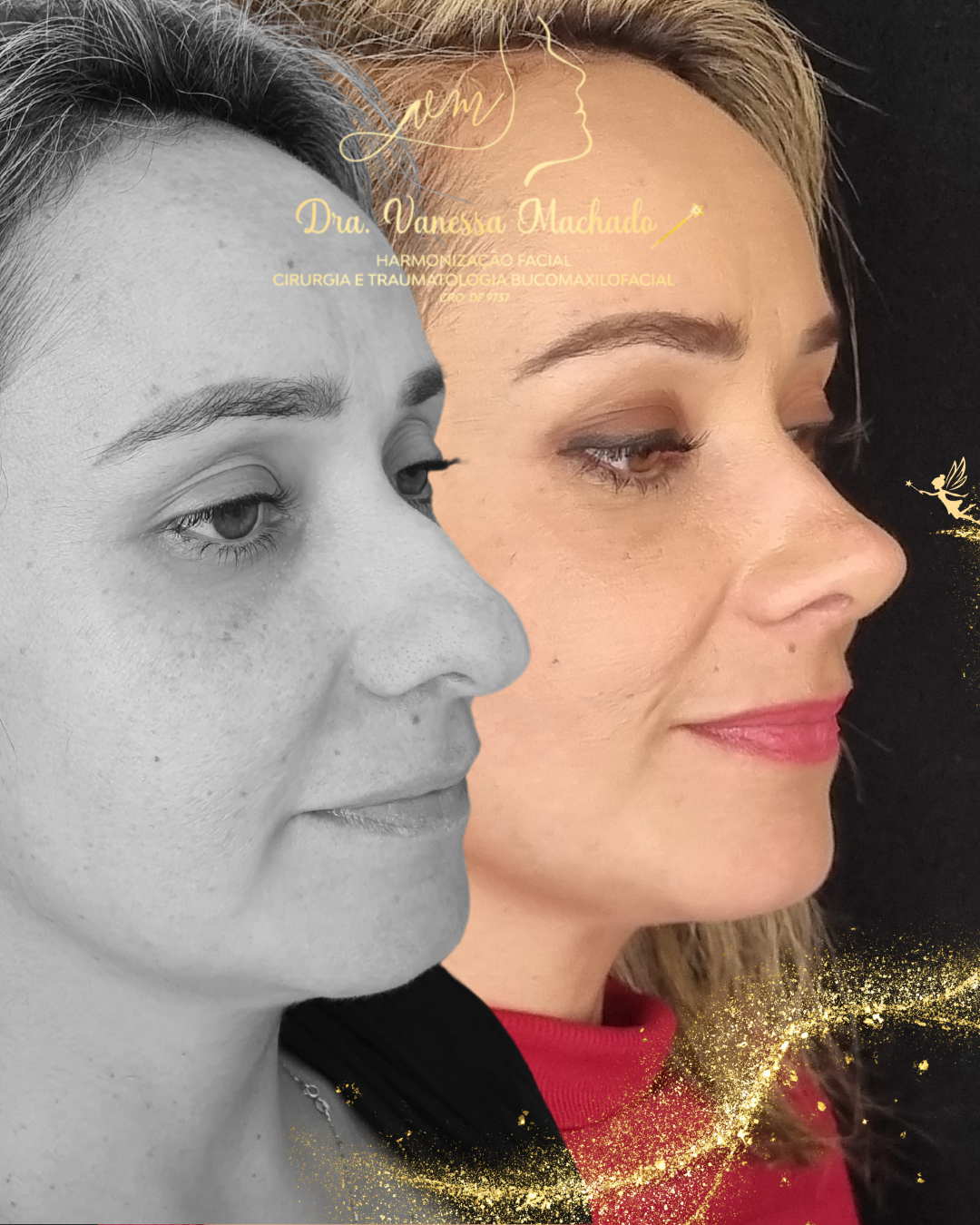 Rinomodelação definitiva estruturada