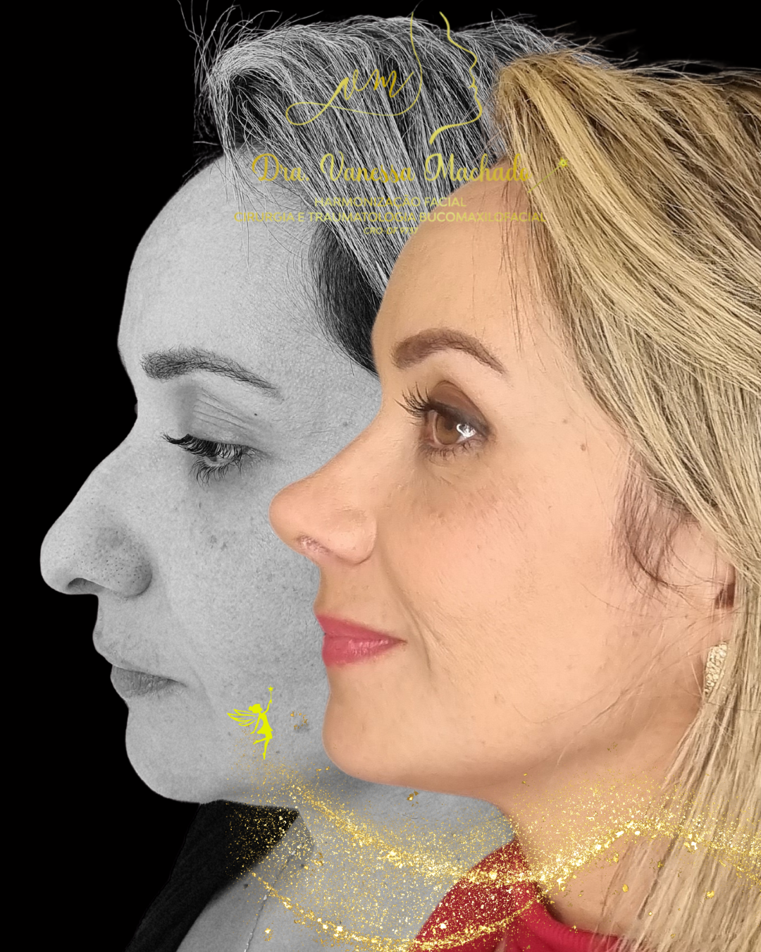 Rinomodelação definitiva estruturada