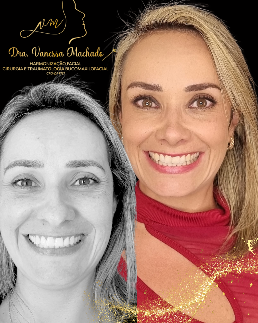 Rinomodelação definitiva estruturada