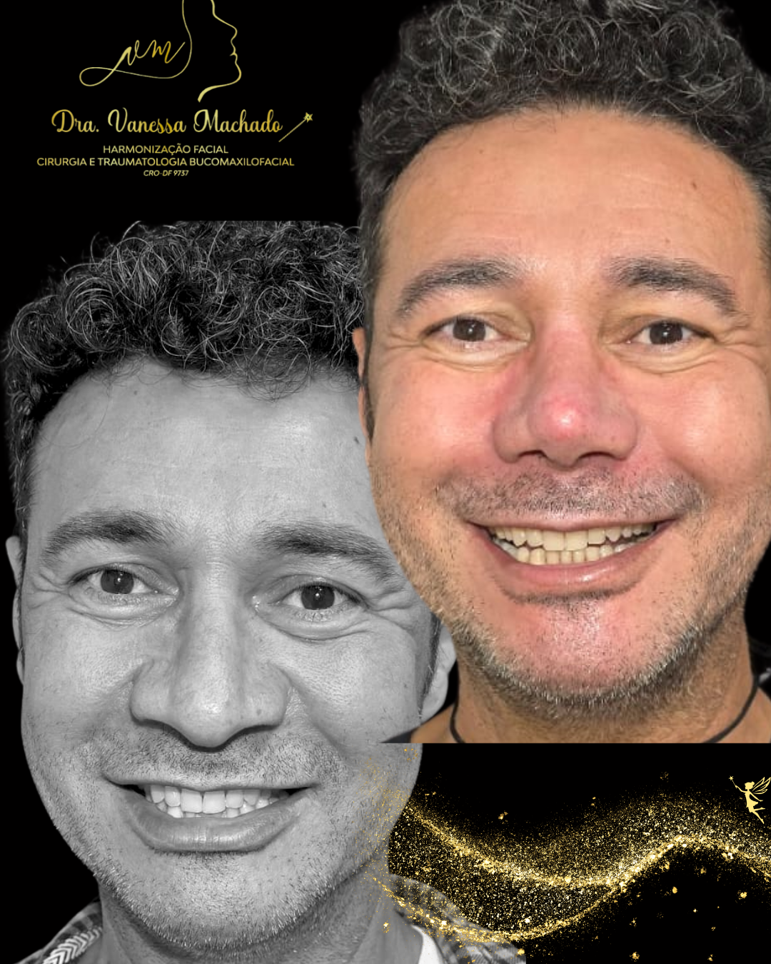 Rinomodelação definitiva estruturada