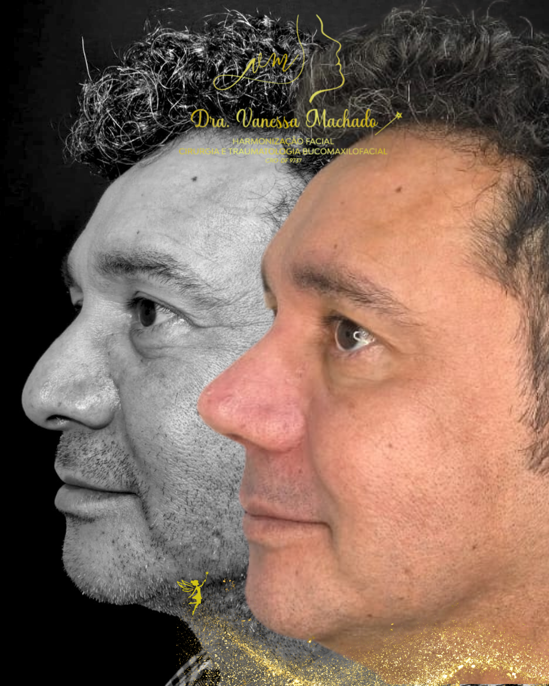 Rinomodelação definitiva estruturada