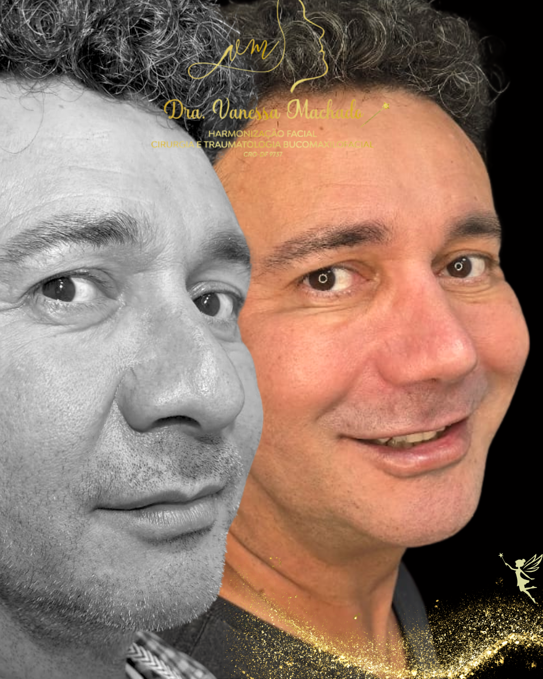 Rinomodelação definitiva estruturada