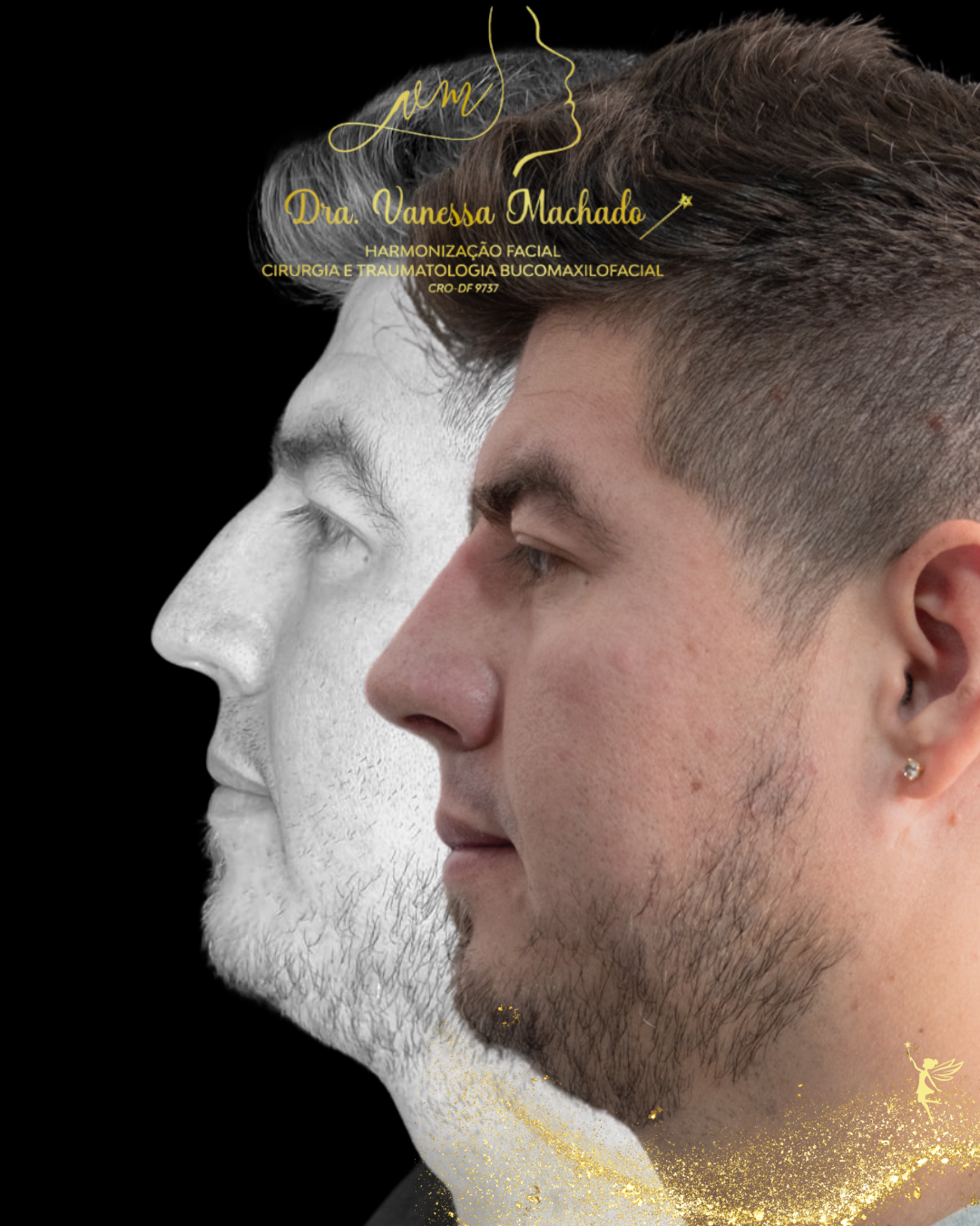 Rinomodelação definitiva estruturada