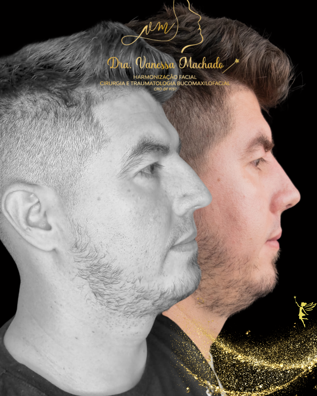 Rinomodelação definitiva estruturada