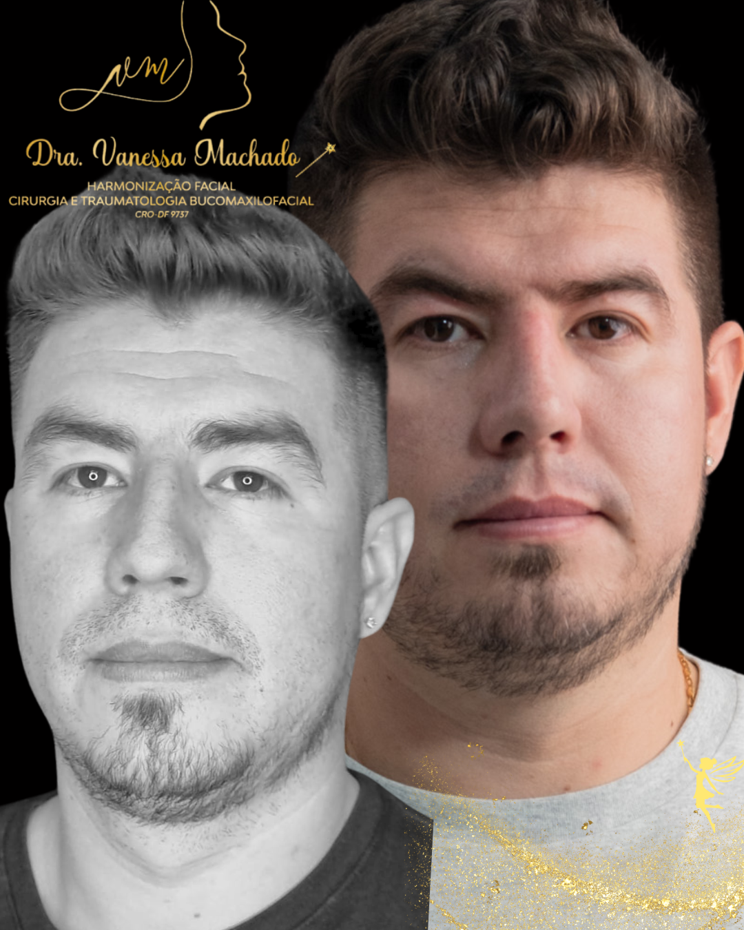 Rinomodelação definitiva estruturada