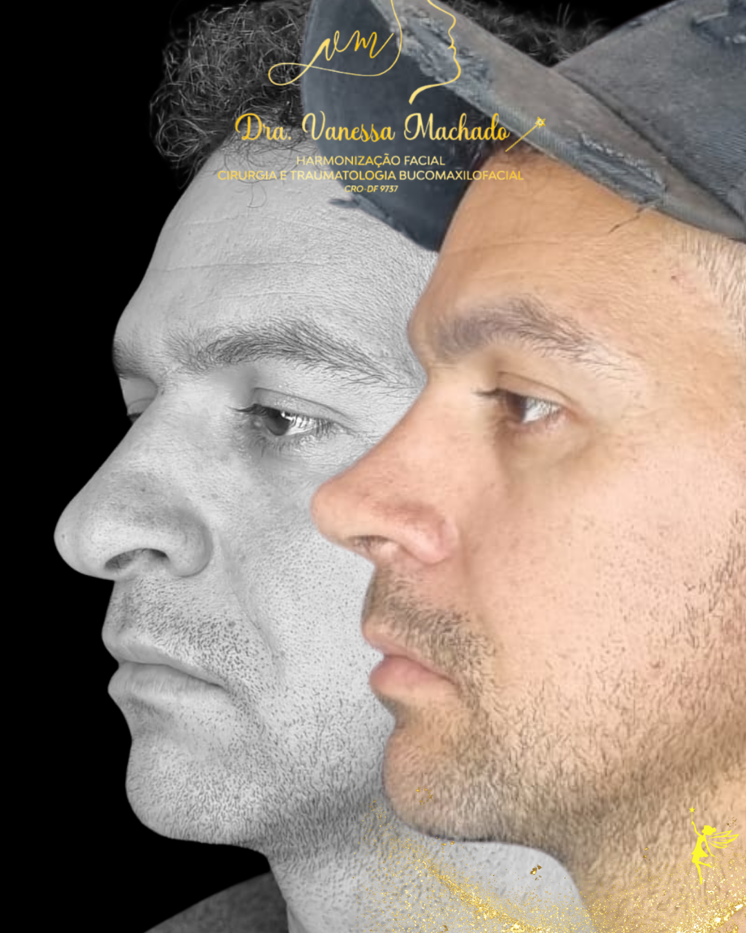 Rinomodelação definitiva estruturada