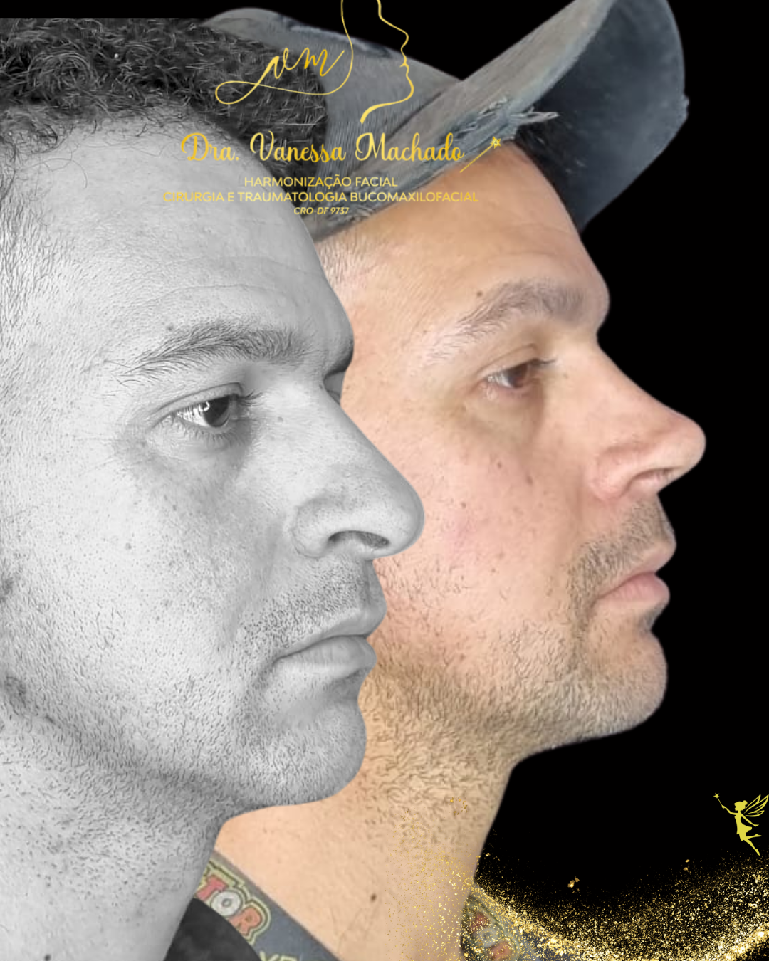 Rinomodelação definitiva estruturada