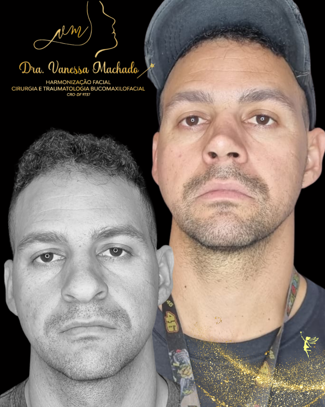 Rinomodelação definitiva estruturada