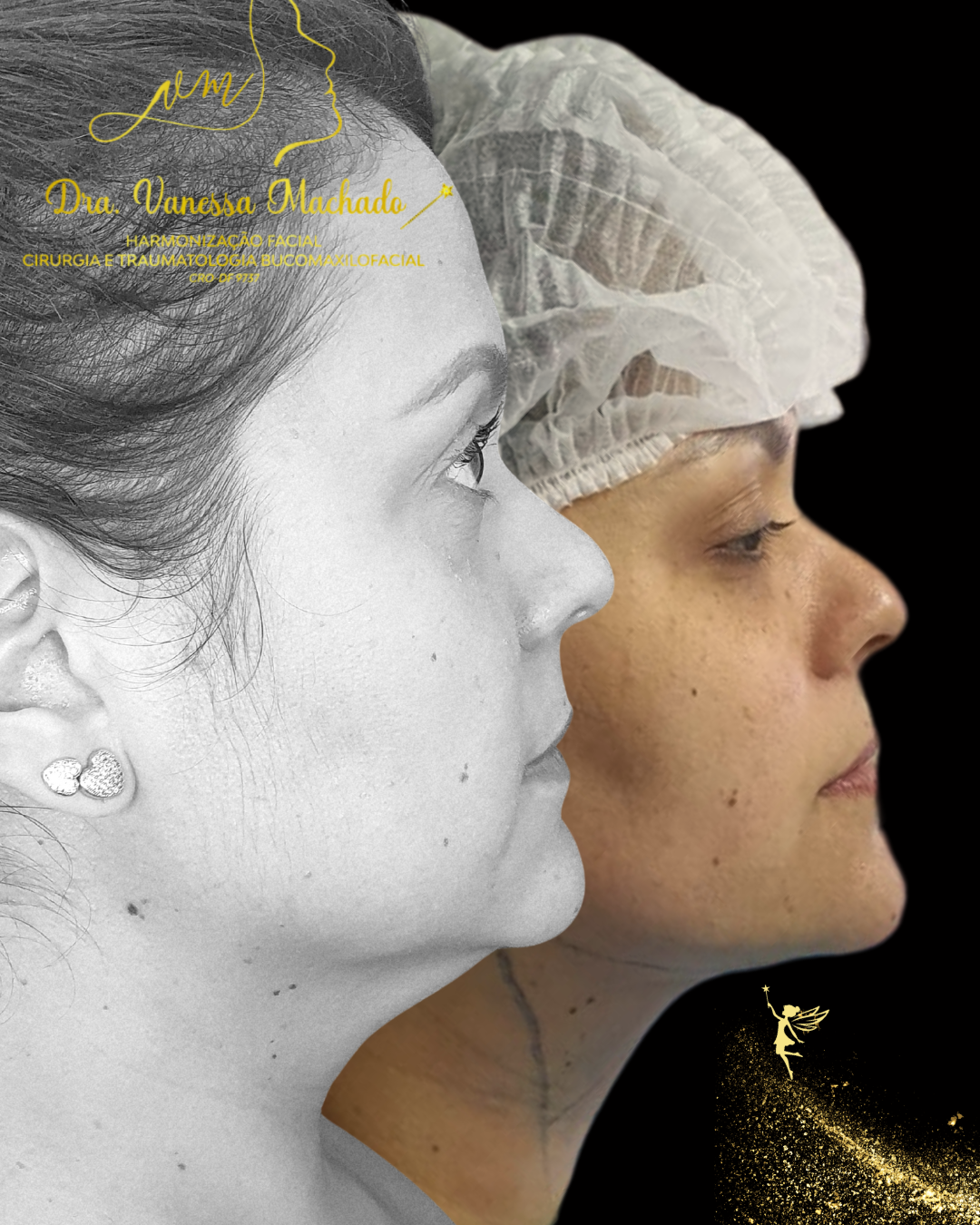 PROTOCOLO DE EMAGRECIMENTO FACIAL