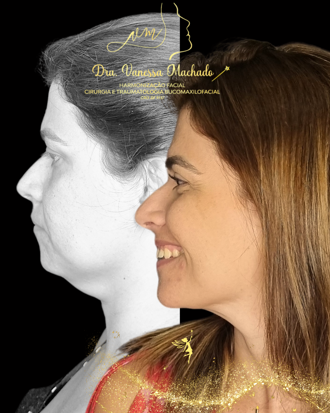PROTOCOLO DE EMAGRECIMENTO FACIAL