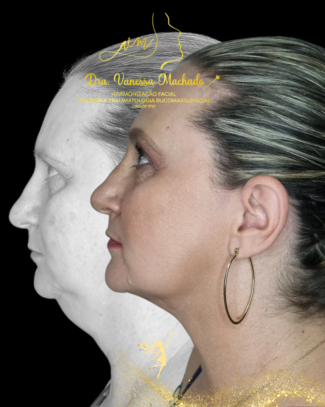 PROTOCOLO DE EMAGRECIMENTO FACIAL