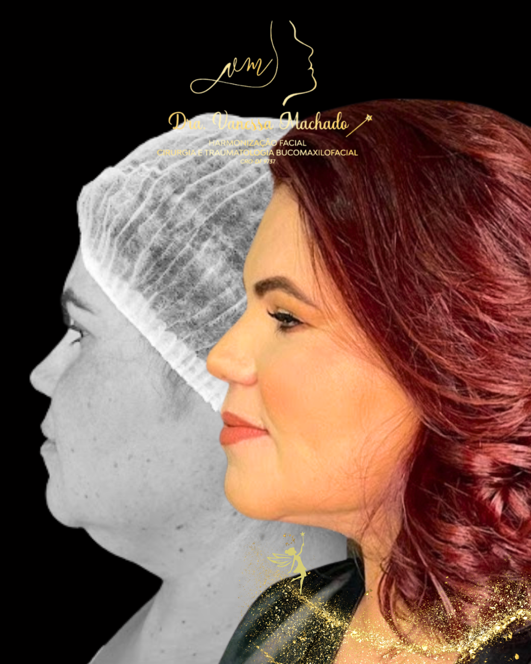 PROTOCOLO DE EMAGRECIMENTO FACIAL