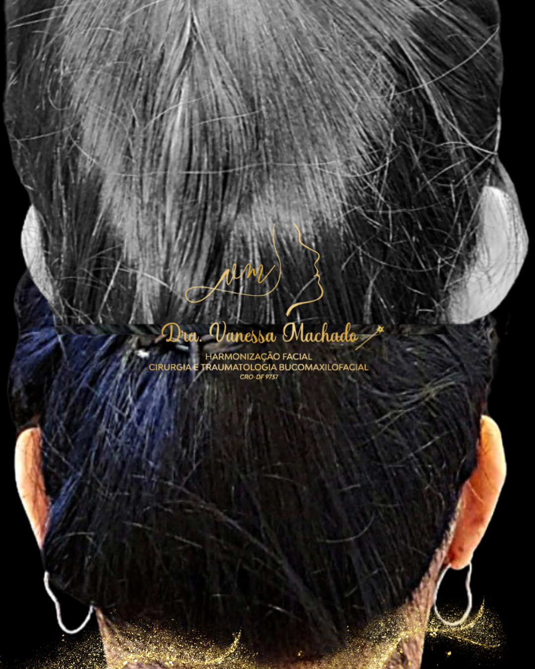 REMODELAÇÃO DEFINITIVA DAS ORELHAS