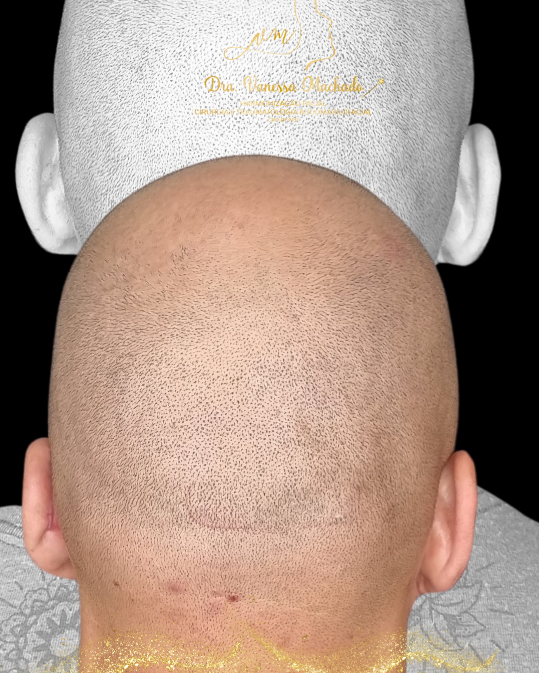 REMODELAÇÃO DEFINITIVA DAS ORELHAS