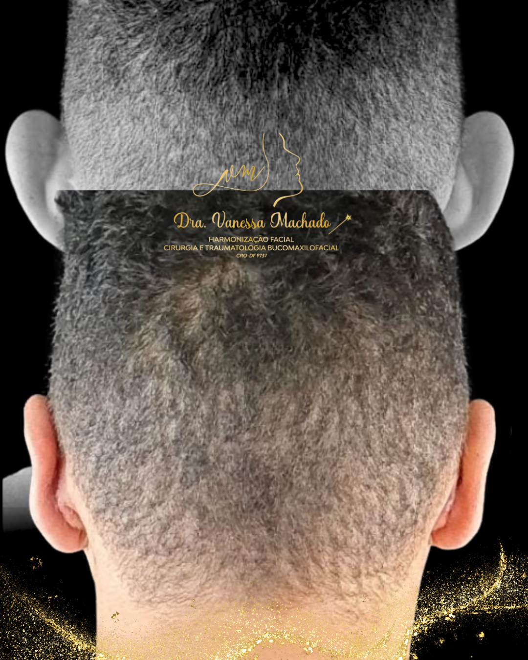 REMODELAÇÃO DEFINITIVA DAS ORELHAS