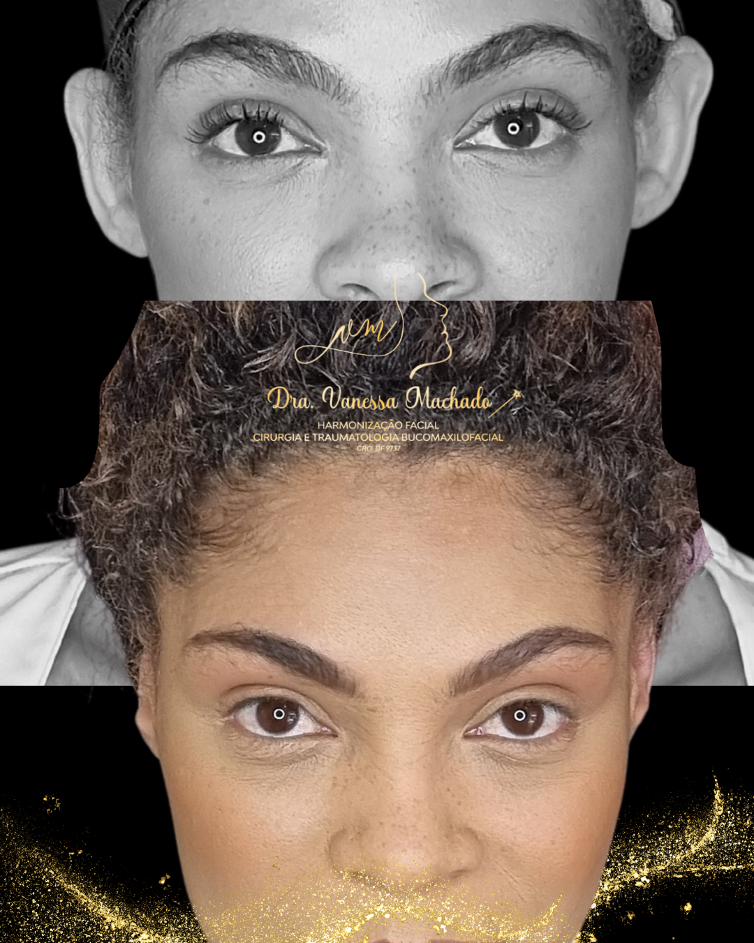 REMODELAÇÃO DEFINITIVA DAS ORELHAS