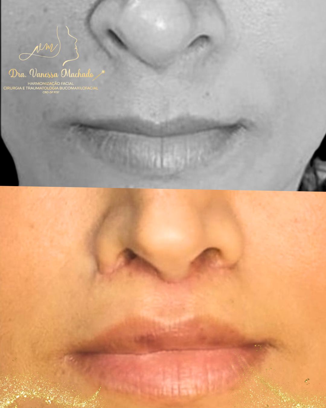 LIP LIFT (LIFTING LABIAL