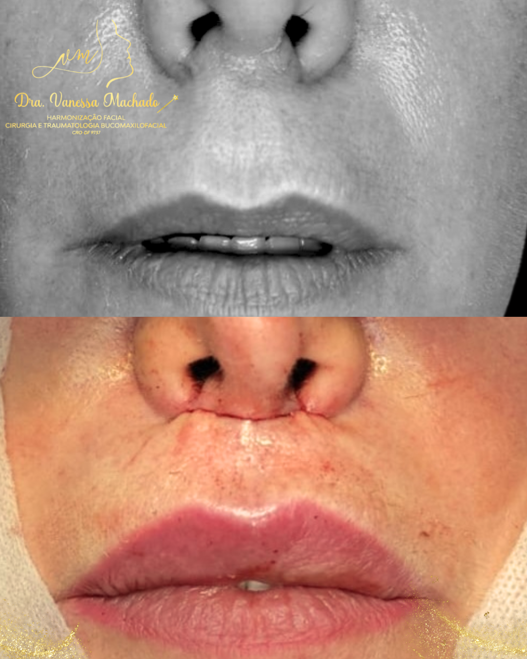 LIP LIFT (LIFTING LABIAL